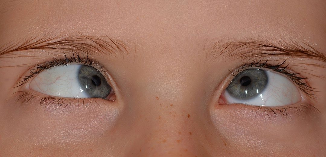 Prise en charge de l’allergie oculaire chez l’enfant